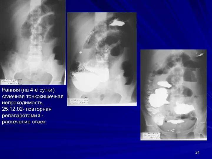 Ранняя (на 4-е сутки) спаечная тонкокишечная непроходимость, 25.12.02- повторная релапаротомия - рассечение спаек