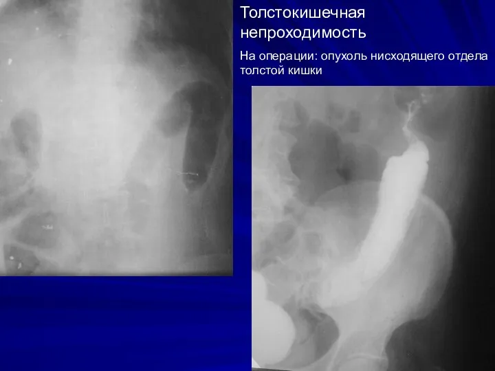 Толстокишечная непроходимость На операции: опухоль нисходящего отдела толстой кишки