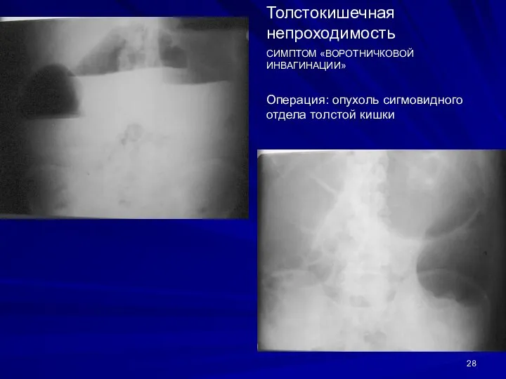 Толстокишечная непроходимость СИМПТОМ «ВОРОТНИЧКОВОЙ ИНВАГИНАЦИИ» Операция: опухоль сигмовидного отдела толстой кишки