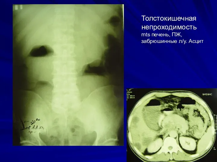 Толстокишечная непроходимость mts печень, ПЖ, забрюшинные л/у. Асцит