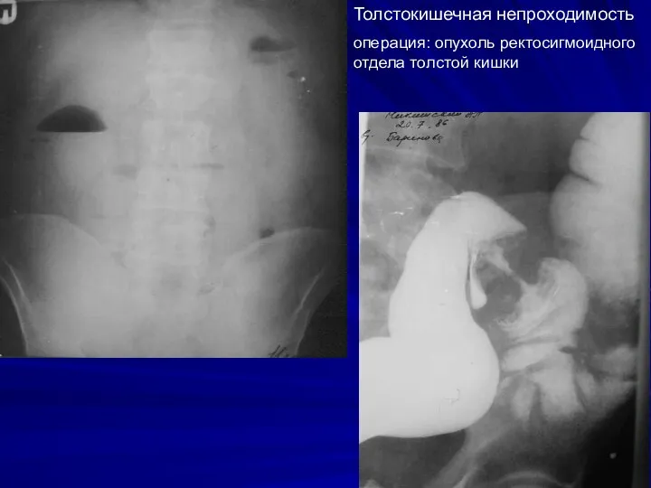 Толстокишечная непроходимость операция: опухоль ректосигмоидного отдела толстой кишки