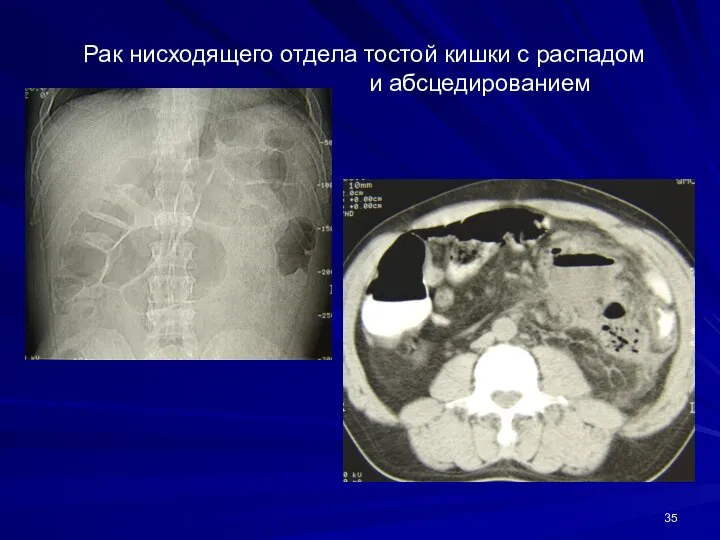 Рак нисходящего отдела тостой кишки с распадом и абсцедированием