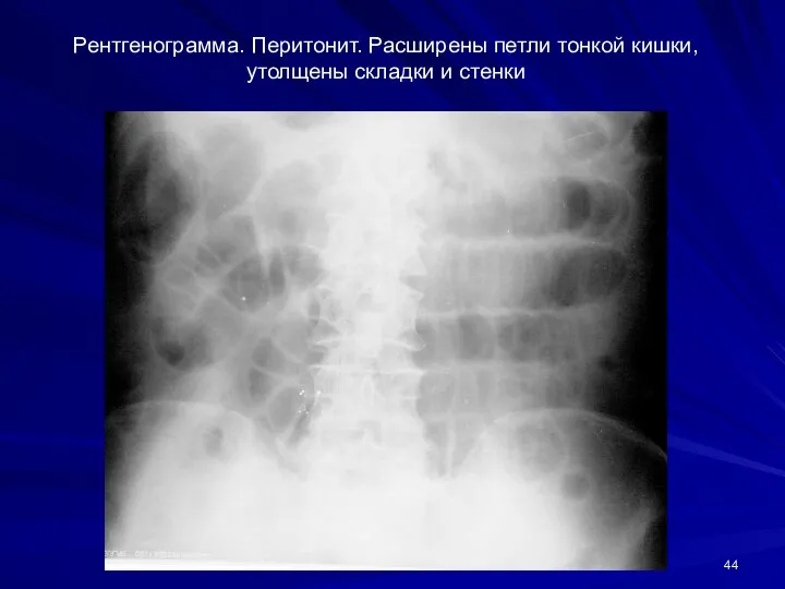 Рентгенограмма. Перитонит. Расширены петли тонкой кишки, утолщены складки и стенки