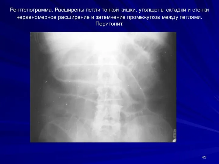 Рентгенограмма. Расширены петли тонкой кишки, утолщены складки и стенки неравномерное расширение