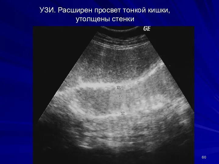 УЗИ. Расширен просвет тонкой кишки, утолщены стенки