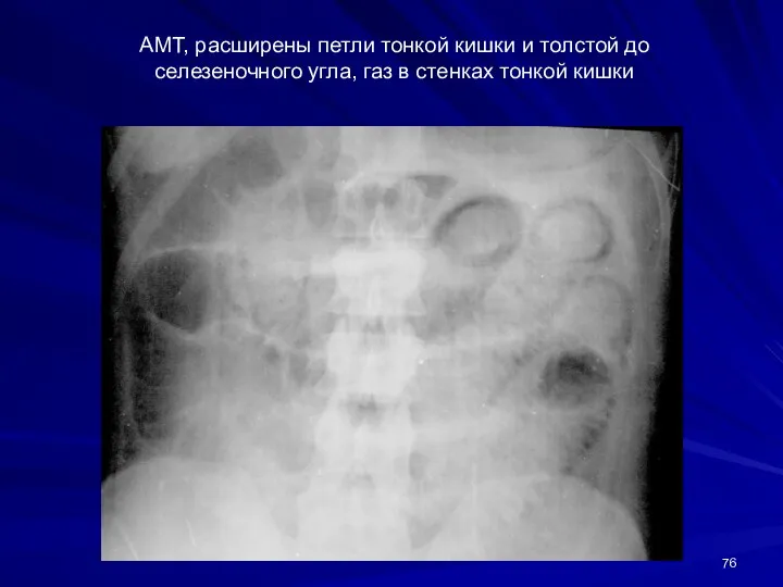 АМТ, расширены петли тонкой кишки и толстой до селезеночного угла, газ в стенках тонкой кишки