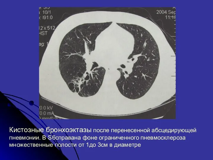 Кистозные бронхоэктазы после перенесенной абсцедирующей пневмонии. В S6справана фоне ограниченного пневмосклероза