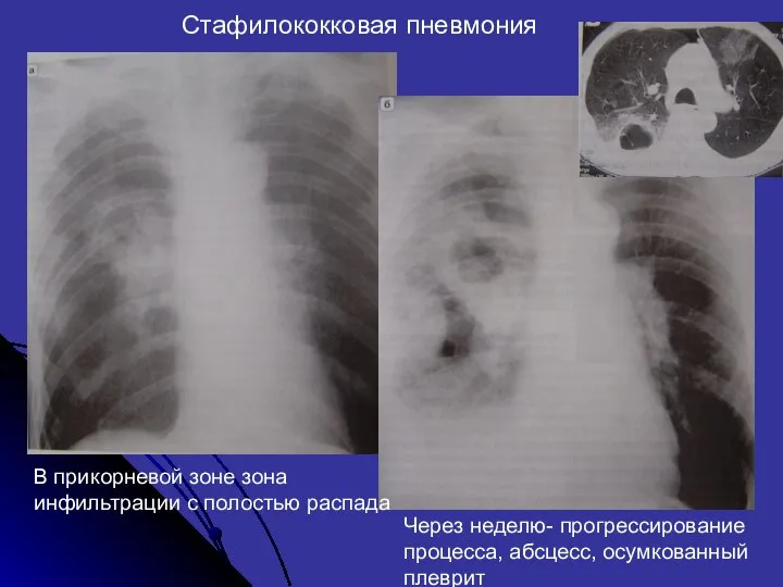 Стафилококковая пневмония В прикорневой зоне зона инфильтрации с полостью распада Через
