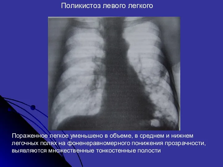 Поликистоз левого легкого Пораженное легкое уменьшено в объеме, в среднем и