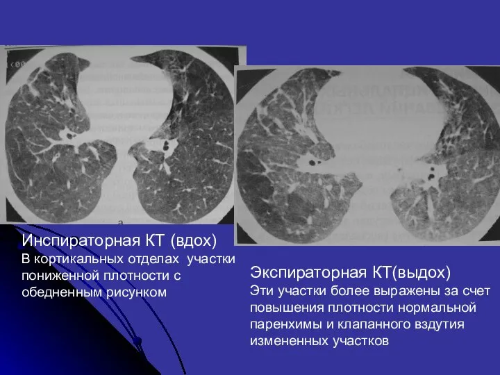 Инспираторная КТ (вдох) В кортикальных отделах участки пониженной плотности с обедненным