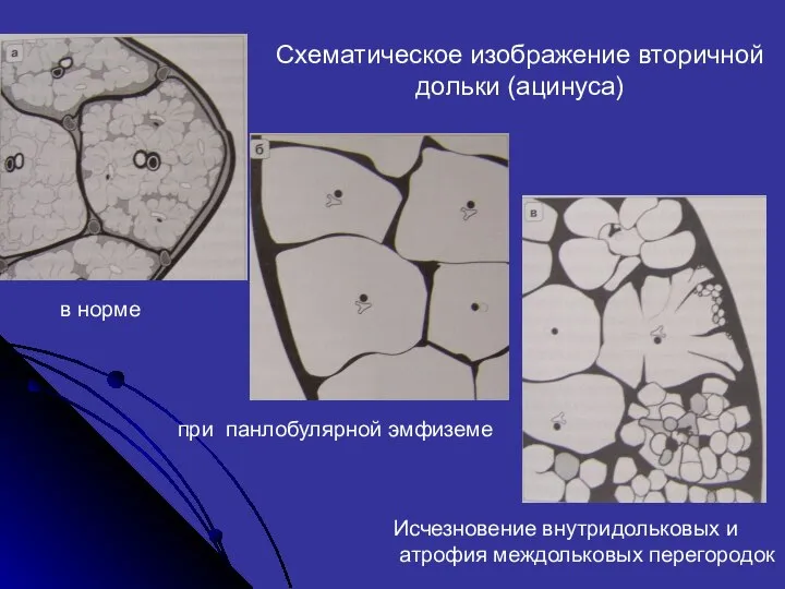 Схематическое изображение вторичной дольки (ацинуса) в норме при панлобулярной эмфиземе Исчезновение внутридольковых и атрофия междольковых перегородок