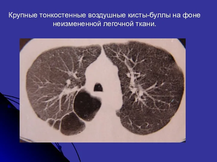 Крупные тонкостенные воздушные кисты-буллы на фоне неизмененной легочной ткани.