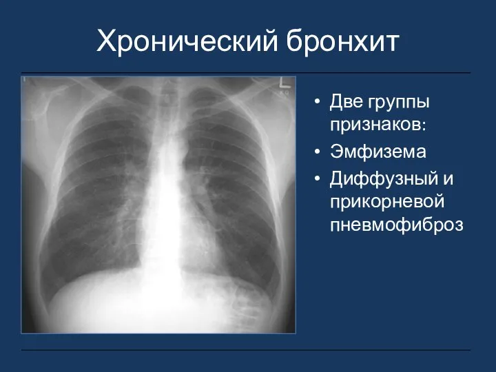 Хронический бронхит Две группы признаков: Эмфизема Диффузный и прикорневой пневмофиброз