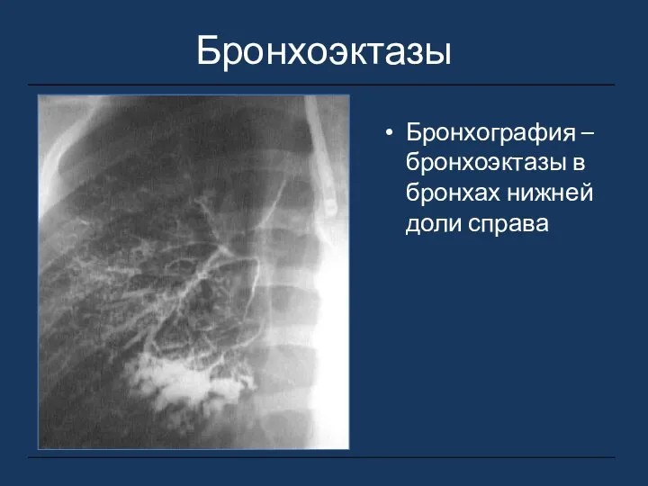 Бронхоэктазы Бронхография – бронхоэктазы в бронхах нижней доли справа