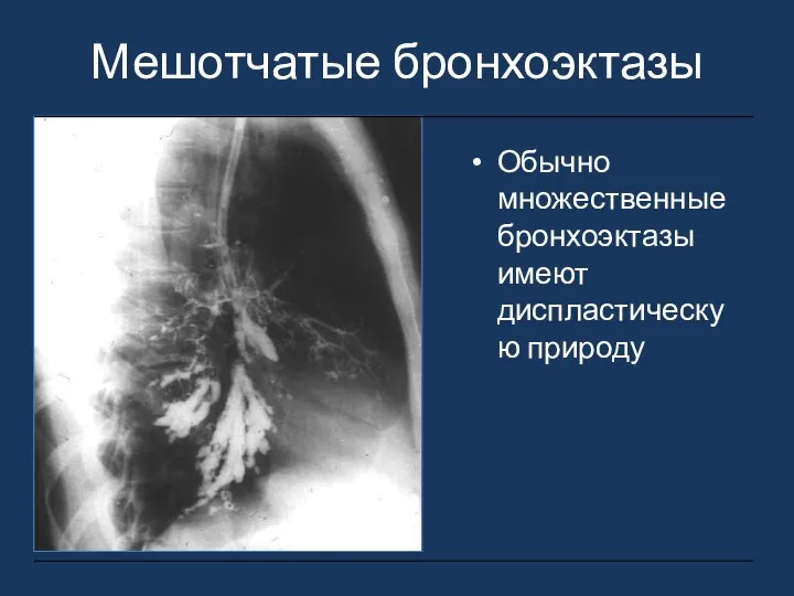 Мешотчатые бронхоэктазы Обычно множественные бронхоэктазы имеют диспластическую природу