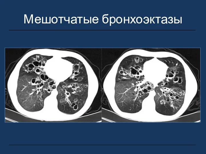 Мешотчатые бронхоэктазы