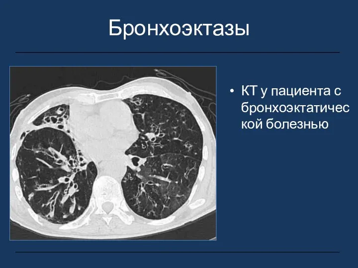 Бронхоэктазы КТ у пациента с бронхоэктатической болезнью