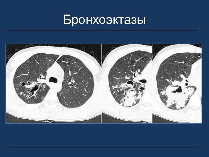 Бронхоэктазы