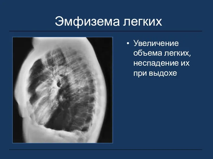 Эмфизема легких Увеличение объема легких, неспадение их при выдохе