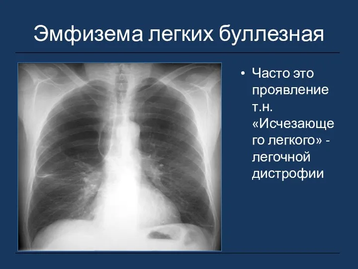 Эмфизема легких буллезная Часто это проявление т.н. «Исчезающего легкого» - легочной дистрофии