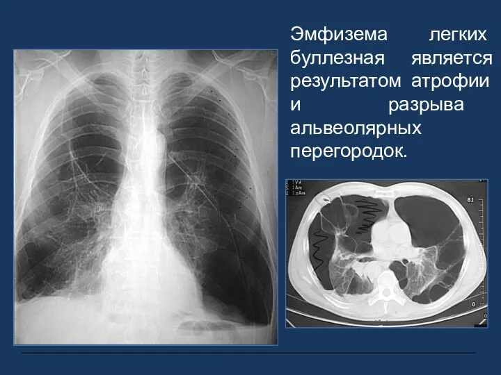 Эмфизема легких буллезная является результатом атрофии и разрыва альвеолярных перегородок.