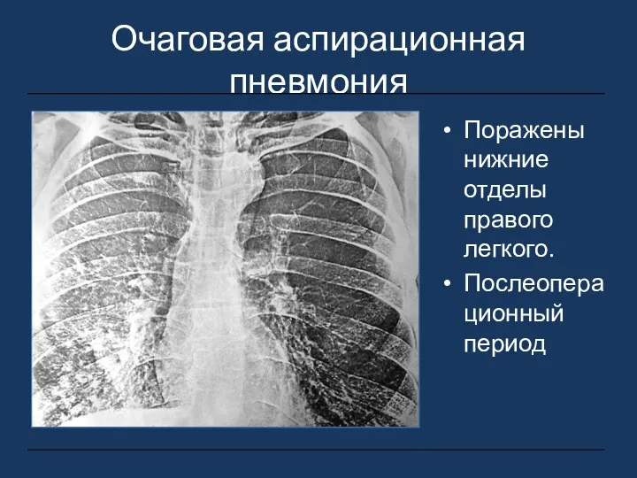 Очаговая аспирационная пневмония Поражены нижние отделы правого легкого. Послеоперационный период