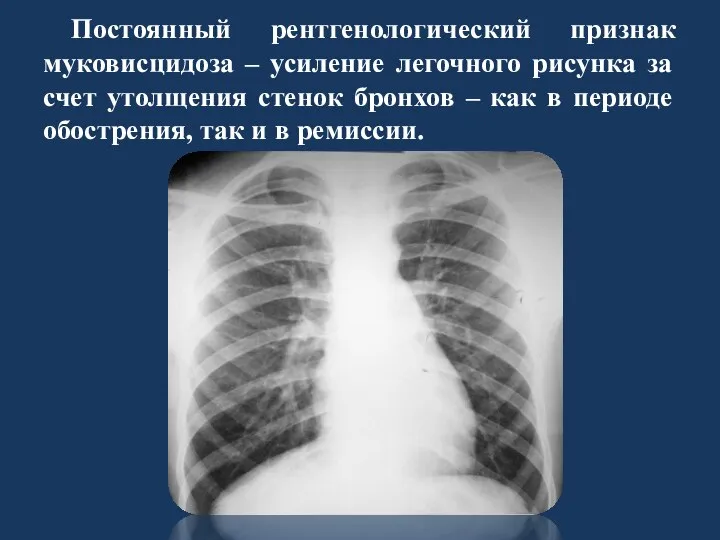 Постоянный рентгенологический признак муковисцидоза – усиление легочного рисунка за счет утолщения