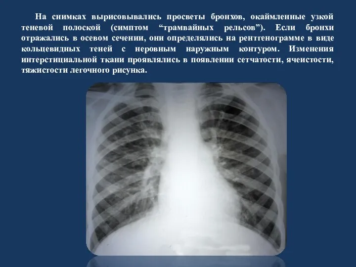 На снимках вырисовывались просветы бронхов, окаймленные узкой теневой полоской (симптом “трамвайных