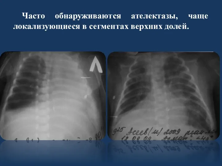 Часто обнаруживаются ателектазы, чаще локализующиеся в сегментах верхних долей.