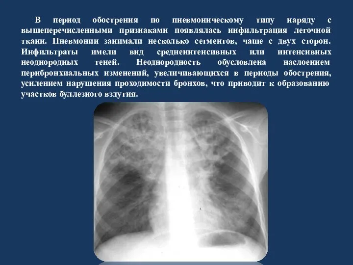 В период обострения по пневмоническому типу наряду с вышеперечисленными признаками появлялась