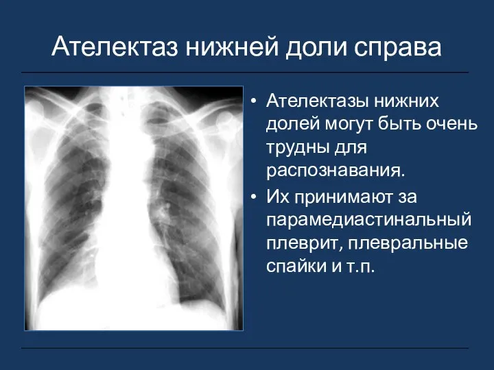 Ателектаз нижней доли справа Ателектазы нижних долей могут быть очень трудны