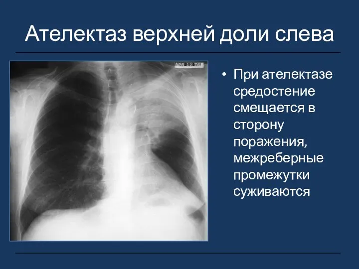 Ателектаз верхней доли слева При ателектазе средостение смещается в сторону поражения, межреберные промежутки суживаются