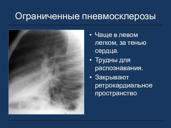 Ограниченные пневмосклерозы Чаще в левом легком, за тенью сердца. Трудны для распознавания. Закрывают ретрокардиальное пространство