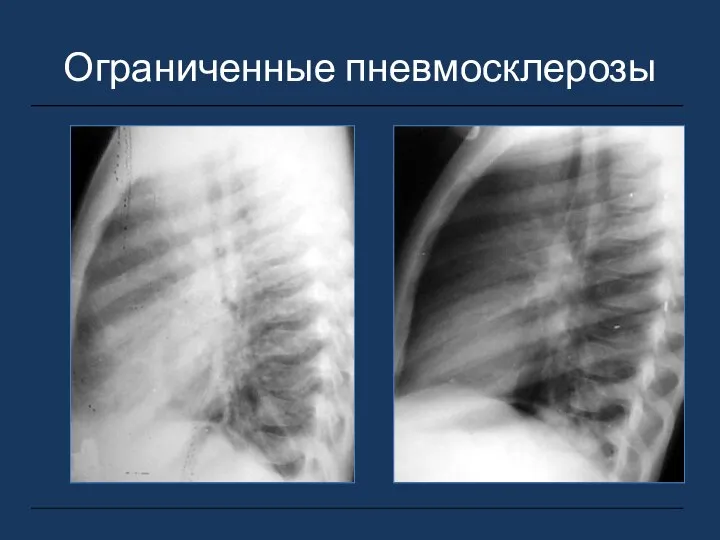 Ограниченные пневмосклерозы