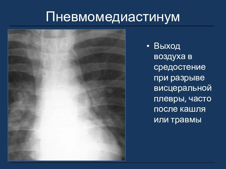 Пневмомедиастинум Выход воздуха в средостение при разрыве висцеральной плевры, часто после кашля или травмы