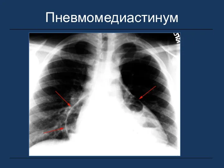 Пневмомедиастинум