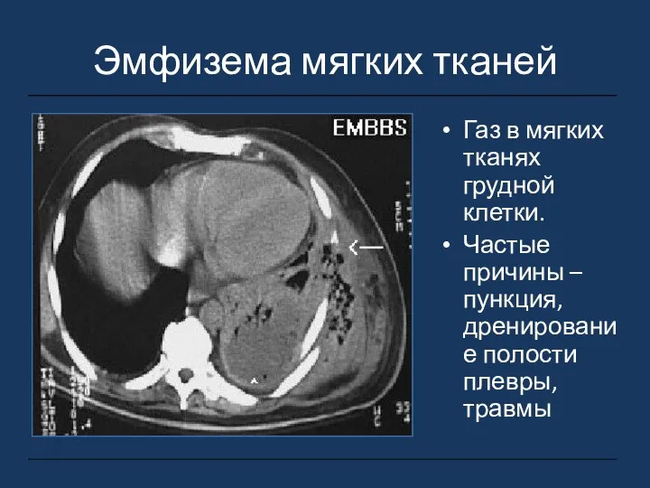 Эмфизема мягких тканей Газ в мягких тканях грудной клетки. Частые причины