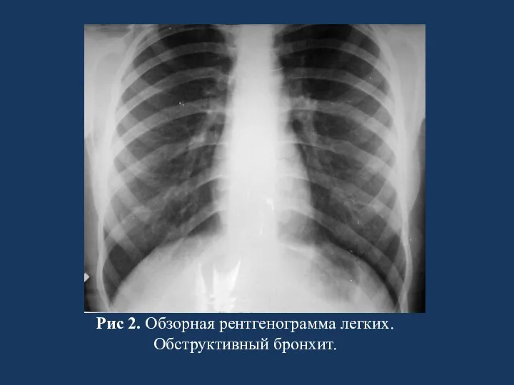 Рис 2. Обзорная рентгенограмма легких. Обструктивный бронхит.