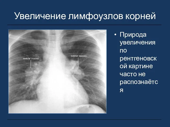 Увеличение лимфоузлов корней Природа увеличения по рентгеновской картине часто не распознаётся