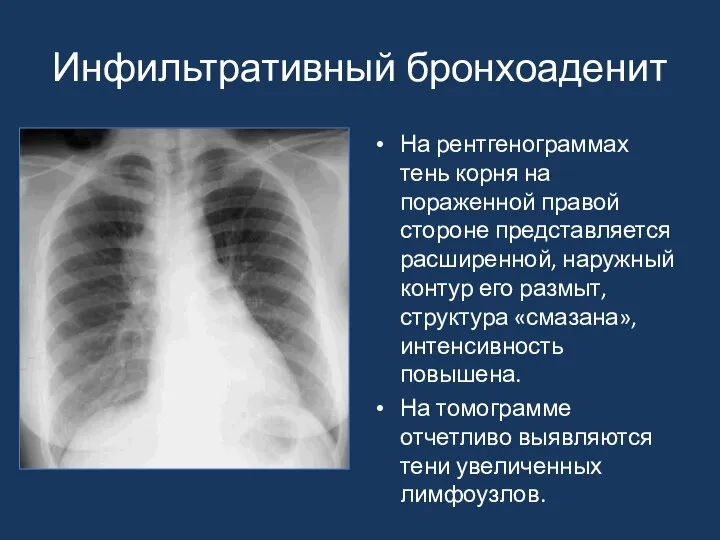 Инфильтративный бронхоаденит На рентгенограммах тень корня на пораженной правой стороне представляется