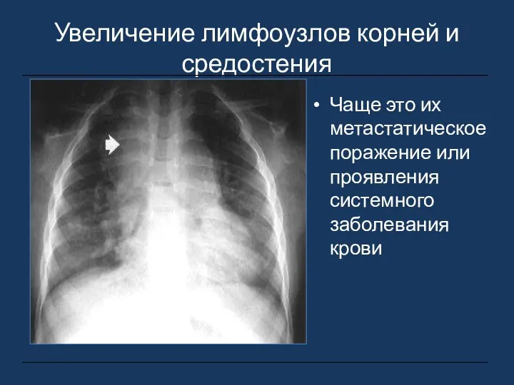 Увеличение лимфоузлов корней и средостения Чаще это их метастатическое поражение или проявления системного заболевания крови