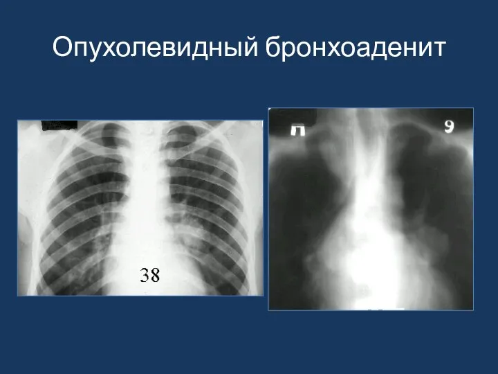 Опухолевидный бронхоаденит