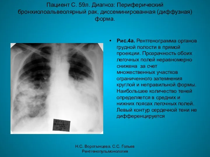 Н.С. Воротынцева. С.С. Гольев Рентгенопульмонология Пациент С. 59л. Диагноз: Периферический бронхиолоальвеолярный