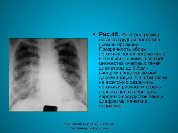 Н.С. Воротынцева. С.С. Гольев Рентгенопульмонология Рис.4б. Рентгенограмма органов грудной полости в