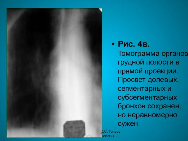 Н.С. Воротынцева. С.С. Гольев Рентгенопульмонология Рис. 4в. Томограмма органов грудной полости