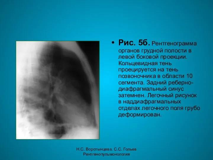 Н.С. Воротынцева. С.С. Гольев Рентгенопульмонология Рис. 5б. Рентгенограмма органов грудной полости