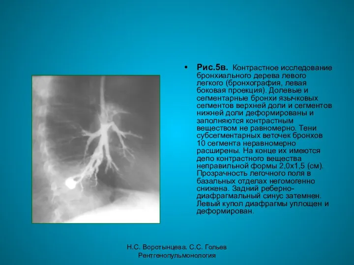 Н.С. Воротынцева. С.С. Гольев Рентгенопульмонология Рис.5в. Контрастное исследование бронхиального дерева левого