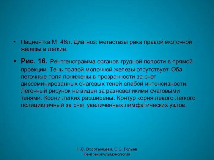 Н.С. Воротынцева. С.С. Гольев Рентгенопульмонология Пациентка М. 48л. Диагноз: метастазы рака