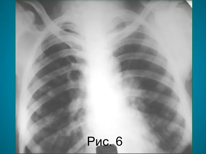 Н.С. Воротынцева. С.С. Гольев Рентгенопульмонология Рис. 6