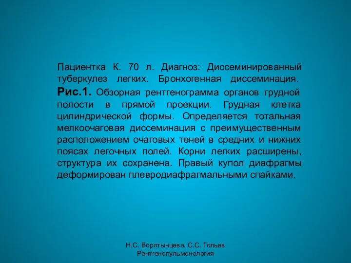 Н.С. Воротынцева. С.С. Гольев Рентгенопульмонология Пациентка К. 70 л. Диагноз: Диссеминированный